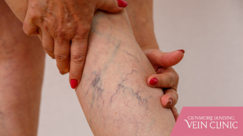 How to Prevent Varicose Veins From Reoccurring