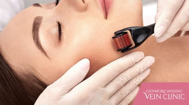 The Benefits of Microneedling For Hyperpigmentation